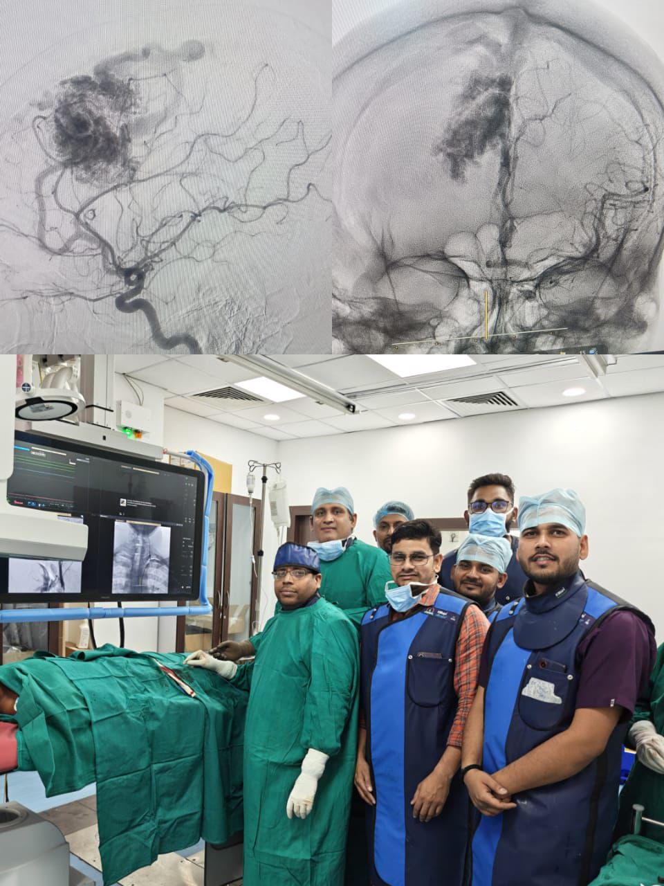 एस. एन. मेडिकल कॉलेज, आगरा में चिकित्सा क्षेत्र में ऐतिहासिक छलांग: पहली बार मस्तिष्क की डिजिटल सब्सट्रैक्शन एंजियोग्राफी (DSA) सफलतापूर्वक संपन्न