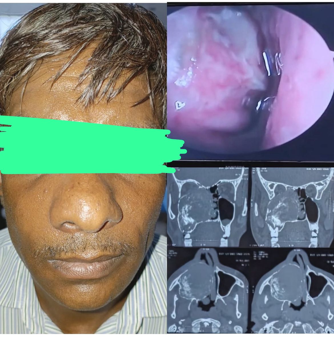 आगरा: एसएन मेडिकल कॉलेज में जबड़े का विशालकाय ट्यूमर सफलतापूर्वक निकाला गया, मरीज की आंख बची
